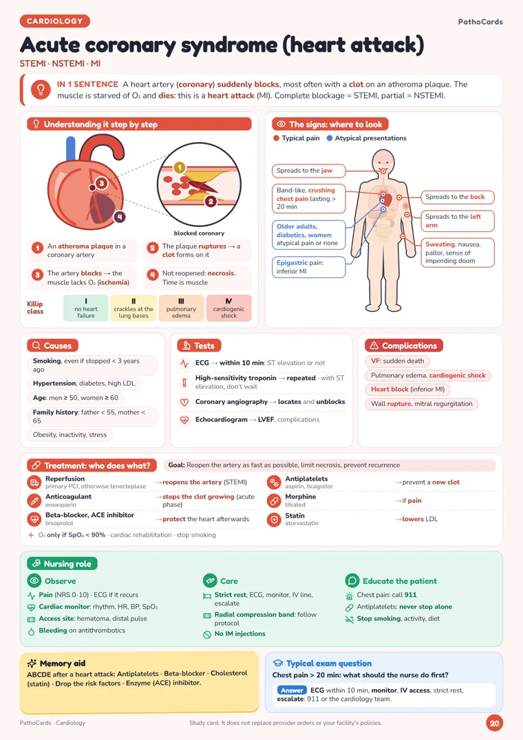 Acute coronary syndrome (heart attack) card from PathoCards